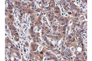 IHC-P Image Transferrin antibody [N3C3] detects Transferrin protein at cytoplasm in human esophageal carcinoma by immunohistochemical analysis. (Transferrin anticorps)