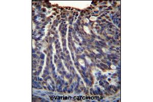 HOXB3 Antibody (Center) (ABIN656507 and ABIN2845779) immunohistochemistry analysis in formalin fixed and paraffin embedded human ovarian carcinoma followed by peroxidase conjugation of the secondary antibody and DAB staining. (HOXB3 anticorps  (AA 119-148))