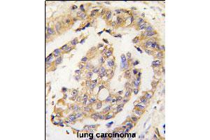 Formalin-fixed and paraffin-embedded human lung carcinoma tissue reacted with OLFM1 polyclonal antibody  , which was peroxidase-conjugated to the secondary antibody, followed by DAB staining.