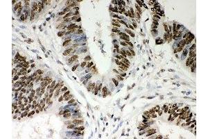 IHC-P: Nucleophosmin antibody testing of human intestine cancer tissue (NPM1 anticorps  (AA 1-294))