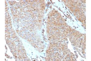 Formalin-fixed, paraffin-embedded human Urothelial Carcinoma stained with PAI-RBP1 Mouse Monoclonal Antibody (SERBP1/3493).