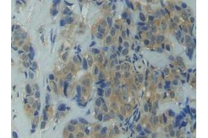 DAB staining on IHC-P; Samples: Human Breast cancer Tissue (HSP90AA1 anticorps  (AA 698-732))