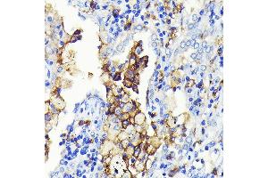 Immunohistochemistry of paraffin-embedded human lung cancer using CD14 Rabbit mAb (ABIN7266167) at dilution of 1:100 (40x lens). (CD14 anticorps)