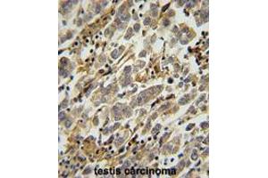 ASB17 Antibody (C-term) immunohistochemistry analysis in formalin fixed and paraffin embedded human testis carcinoma followed by peroxidase conjugation of the secondary antibody and DAB staining.