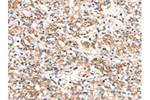 The image on the left is immunohistochemistry of paraffin-embedded Human prostate cancer tissue using ABIN7192435(SLC24A3 Antibody) at dilution 1/20, on the right is treated with synthetic peptide. (SLC24A3 anticorps)