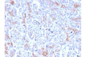 Formalin-fixed, paraffin-embedded human Pancreatic Carcinoma stained with MRP3 Mouse Monoclonal Antibody (ABCC3/2971). (ABCC3 anticorps  (AA 815-957))