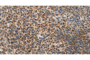 Immunohistochemistry of paraffin-embedded Human liver cancer using UPF1 Polyclonal Antibody at dilution of 1:35 (RENT1/UPF1 anticorps)