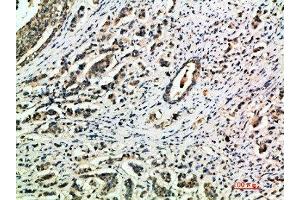 Immunohistochemical analysis of paraffin-embedded human-breast-cancer, antibody was diluted at 1:200 (Integrin alpha 1 anticorps  (AA 920-980))