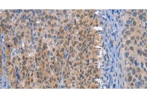 Immunohistochemistry of paraffin-embedded Human cervical cancer tissue using UCK1 Polyclonal Antibody at dilution 1:50 (UCK1 anticorps)