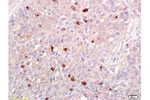 Formalin-fixed and paraffin embedded human lung carcinoma labeled with Anti-ATF2 Polyclonal Antibody, Unconjugated (ABIN669546) at 1:200 followed by conjugation to the secondary antibody and DAB staining. (ATF2 anticorps  (AA 188-255))