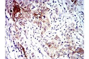 Immunohistochemical analysis of paraffin-embedded esophageal cancer tissues using CD183 mouse mAb with DAB staining. (CXCR3 anticorps)