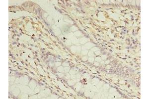 Immunohistochemistry of paraffin-embedded human colon cancer using ABIN7144199 at dilution of 1:100 (ASB8 anticorps  (AA 12-288))