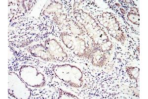Immunohistochemical analysis of paraffin-embedded lung cancer tissues using SMAD4 mouse mAb with DAB staining. (SMAD4 anticorps)