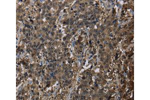 Immunohistochemistry of Human liver cancer using GSTA3 Polyclonal Antibody at dilution of 1:30 (GSTA3 anticorps)