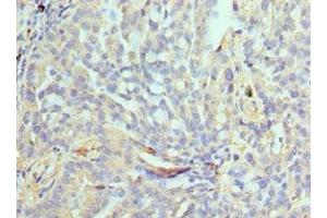 Immunohistochemistry of paraffin-embedded human lung cancer using ABIN7161635 at dilution of 1:100 (NPRL2 anticorps  (AA 1-220))