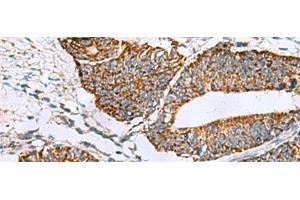 Immunohistochemistry of paraffin-embedded Human colorectal cancer tissue using PRELID3B Polyclonal Antibody at dilution of 1:90(x200)