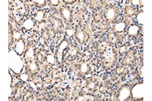 The image on the left is immunohistochemistry of paraffin-embedded Human thyroid cancer tissue using ABIN7127989(PPIL1 Antibody) at dilution 1/30, on the right is treated with fusion protein. (PPIL1 anticorps)