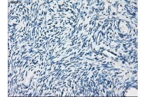 Immunohistochemical staining of paraffin-embedded Adenocarcinoma of breast tissue using anti-PDE10A mouse monoclonal antibody. (PDE10A anticorps)