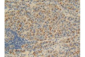DAB staining on IHC-P; Samples: Human Liver cancer Tissue