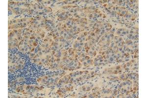 DAB staining on IHC-P; Samples: Human Liver cancer Tissue (FKBP1B anticorps  (AA 2-108))