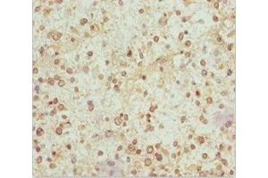 Immunohistochemistry of paraffin-embedded human glioma using ABIN7160986 at dilution of 1:100