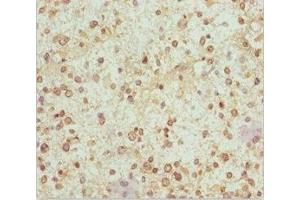 Immunohistochemistry of paraffin-embedded human glioma using ABIN7160986 at dilution of 1:100 (NDUFS1 anticorps  (AA 80-290))