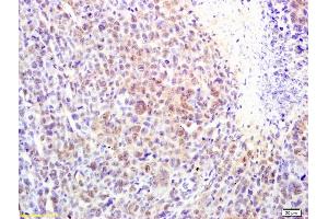 Formalin-fixed and paraffin embedded mouse lymphoma labeled with Rabbit Anti alpha MSH Polyclonal Antibody, Unconjugated (ABIN735323) at 1:200 followed by conjugation to the secondary antibody and DAB staining (MSH alpha (AA 138-150) anticorps)