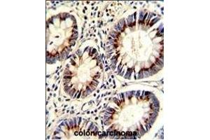 Formalin-fixed and paraffin-embedded human colon carcinoma with TYSY Antibody (C-term), which was peroxidase-conjugated to the secondary antibody, followed by DAB staining.