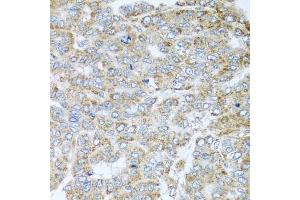 Immunohistochemistry of paraffin-embedded human liver cancer using NDUFA2 antibody. (NDUFA2 anticorps)