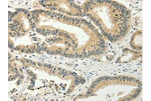The image on the left is immunohistochemistry of paraffin-embedded Human colon cancer tissue using ABIN7128020(SPIN4 Antibody) at dilution 1/20, on the right is treated with fusion protein. (SPIN4 anticorps)
