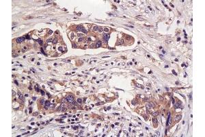 Formalin-fixed and paraffin embedded human endometrial carcinoma labeled with Anti- Hpt/Haptoglobin Polyclonal Antibody, Unconjugated (ABIN734738) at 1:200 followed by conjugation to the secondary antibody and DAB staining (Haptoglobin anticorps  (AA 251-350))