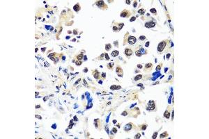 Immunohistochemistry of paraffin-embedded human lung cancer using C antibody (ABIN7266546) at dilution of 1:100 (40x lens). (CAND1 anticorps  (AA 750-980))