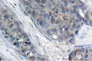 Immunohistochemistry (IHC) analyzes of p-IRS-1 antibody in paraffin-embedded human breast carcinoma tissue. (IRS1 anticorps  (pSer307))