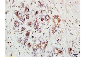 Formalin-fixed and paraffin embedded human breast carcinoma labeled with Anti- RPS3 Polyclonal Antibody, Unconjugated (ABIN872550) at 1:200 followed by conjugation to the secondary antibody (RPS3 anticorps  (AA 101-200))
