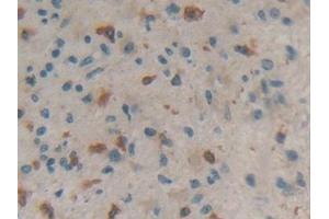 Detection of CORO1A in Human Glioma Tissue using Polyclonal Antibody to Coronin 1A (CORO1A)