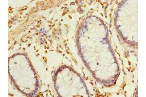 Immunohistochemistry of paraffin-embedded human colon cancer using ABIN7145650 at dilution of 1:100 (BRINP2 anticorps  (AA 34-300))