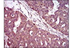 Immunohistochemical analysis of paraffin-embedded ovarian cancer tissues using PIWIL4 mouse mAb with DAB staining. (PIWIL4 anticorps  (AA 304-434))