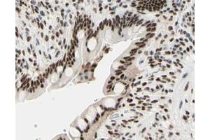 ABIN6267567 at 1/200 staining human colon cancer tissue sections by IHC-P.