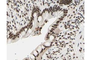 ABIN6267567 at 1/200 staining human colon cancer tissue sections by IHC-P. (Histone H3.1 anticorps  (pSer10))