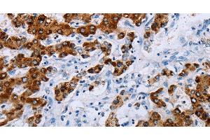 Immunohistochemistry of paraffin-embedded Human liver cancer tissue using NDUFA12 Polyclonal Antibody at dilution 1:50 (NDUFA12 anticorps)