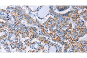 Immunohistochemistry of paraffin-embedded Human thyroid cancer using KIF3A Polyclonal Antibody at dilution of 1:40 (KIF3A anticorps)