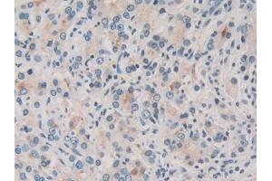 Detection of TOR1A in Human Prostate cancer Tissue using Polyclonal Antibody to Torsin 1A (TOR1A)
