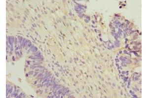 Immunohistochemistry of paraffin-embedded human ovarian cancer using ABIN7166313 at dilution of 1:100 (WNT7B anticorps  (AA 120-349))