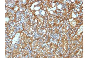 Formalin-fixed, paraffin-embedded human Hepatocellular Carcinoma stained with EpCAM-Monospecific Mouse Monoclonal Antibody (EGP40/1372). (EpCAM anticorps  (Extracellular Domain))
