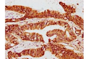 IHC image of ABIN7162837 diluted at 1:400 and staining in paraffin-embedded human colon cancer performed on a Leica BondTM system.