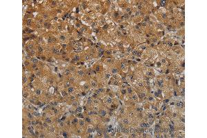Immunohistochemistry of Human thyroid cancer using TAB1 Polyclonal Antibody at dilution of 1:40 (TAB1 anticorps)