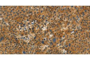 Immunohistochemistry of paraffin-embedded Human liver cancer tissue using NPAP1 Polyclonal Antibody at dilution 1:60 (NPAP1 anticorps)