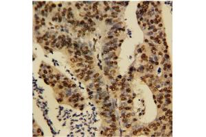 Immunohistochemical staining of Human rectal cancer (TNFAIP1 anticorps  (N-Term))