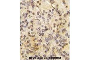 Formalin-fixed and paraffin-embedded human prostata carcinoma tissue reacted with MEN1 Antibody  (ABIN391614 and ABIN2841535) , which was peroxidase-conjugated to the secondary antibody, followed by DAB staining.