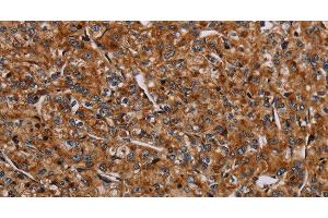 Immunohistochemistry of paraffin-embedded Human prostate cancer using NDUFA8 Polyclonal Antibody at dilution of 1:40
